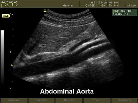 Aorta ultrasound