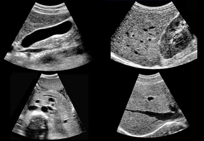 General Abdominal ultrasound scan