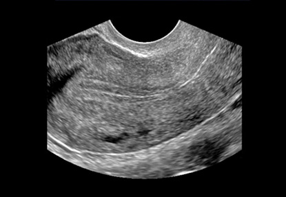 Gyne pelvis scan